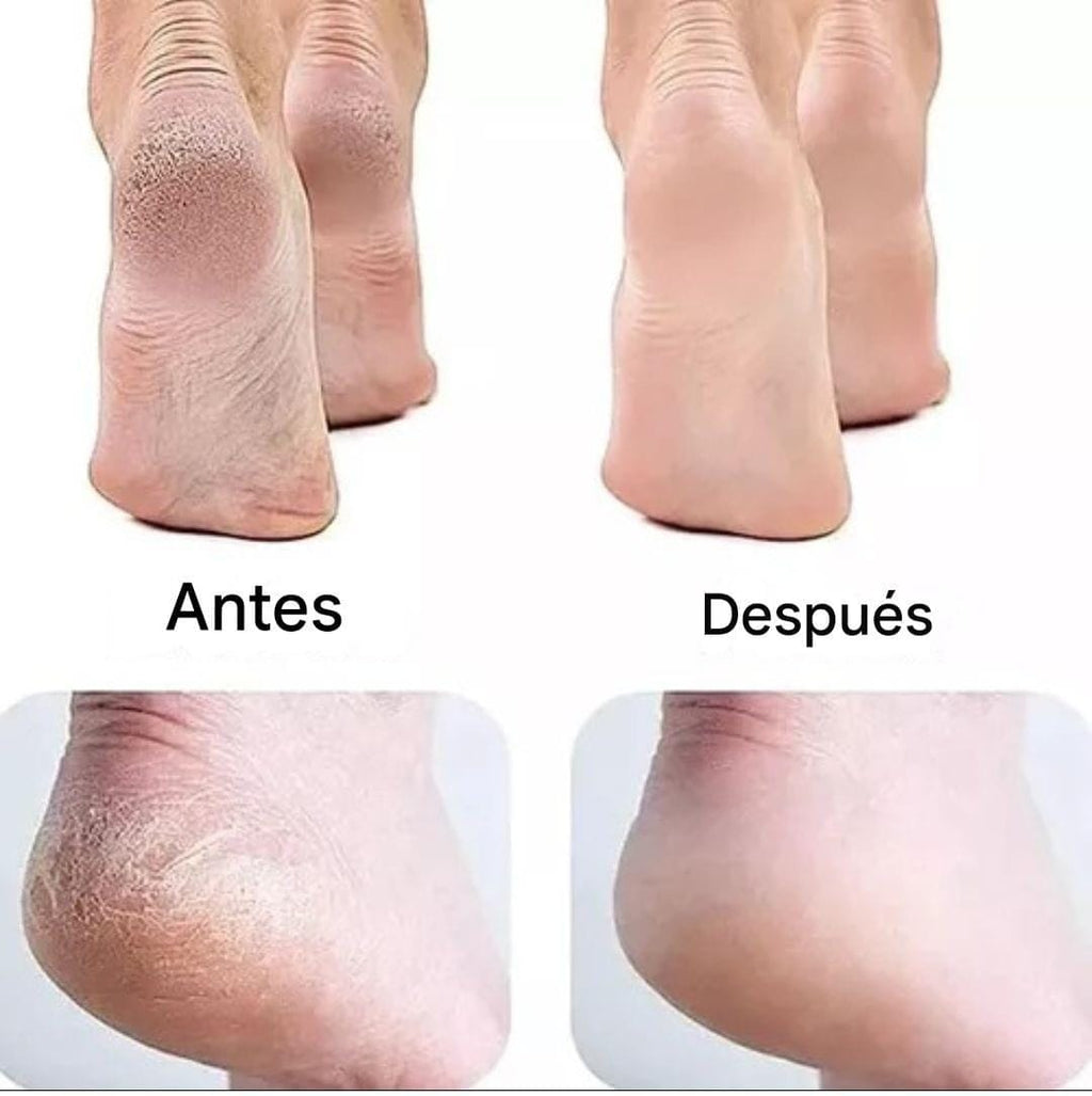 Removedor de Callos Portatil
