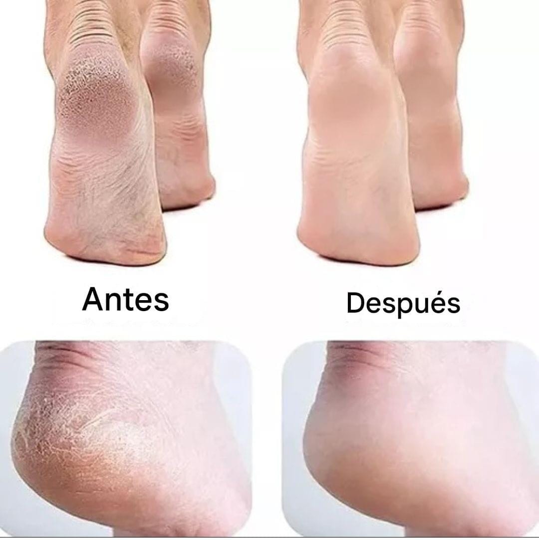 Removedor de Callos Portatil